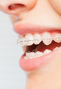 Woman smiling with clear braces near Lewis Center