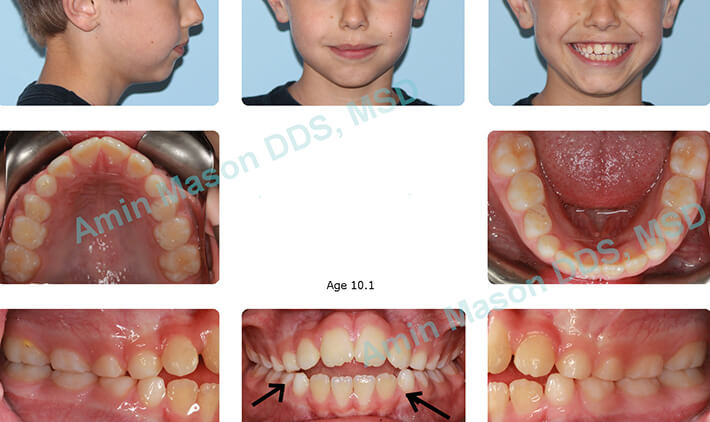 overbite case before