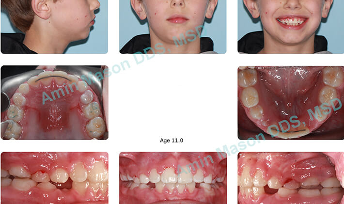 overbite case after