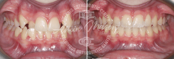 smile case 1