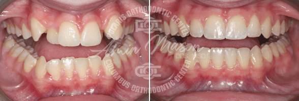 smile case 1