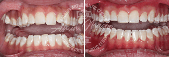 smile case 2