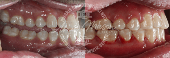 smile case 2