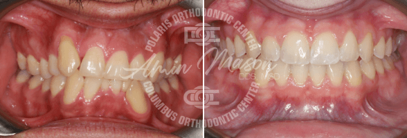 smile case 3