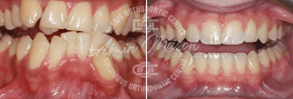 smile case 3