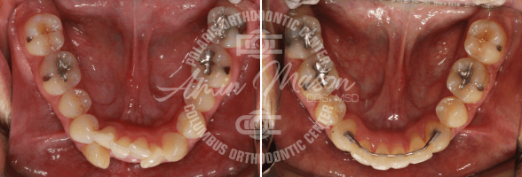 smile case 3