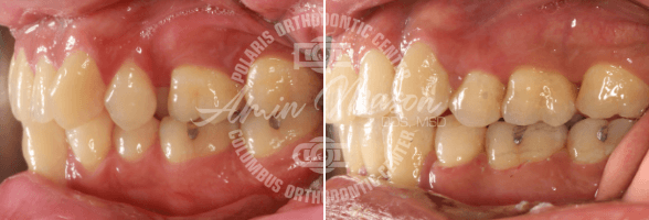 smile case 3