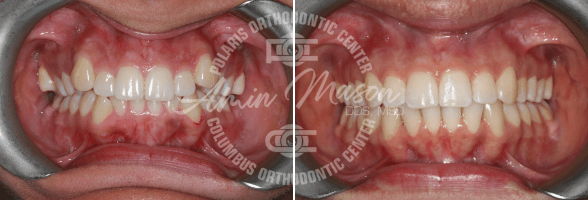 smile case 4