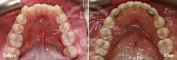 smile case 4
