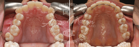 smile case 4