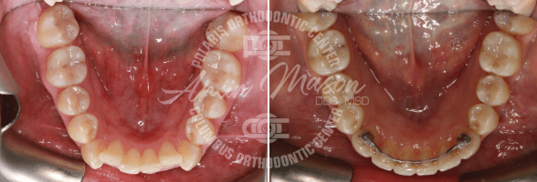 smile case 4