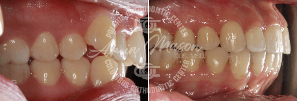 smile case 4