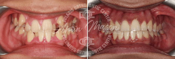 smile case 5