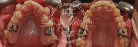 smile case 5