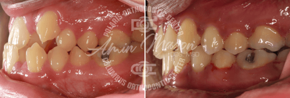 smile case 5