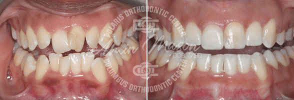 smile case 6