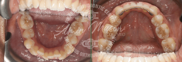 smile case 6