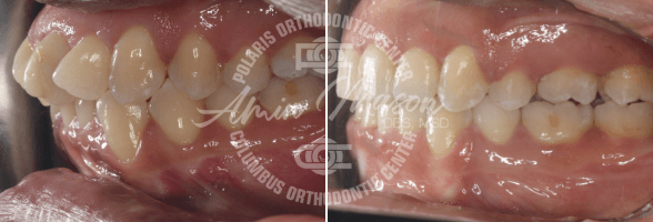smile case 6