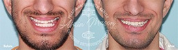Man smiling before and after surgical treatment with braces