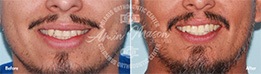 Man smiling before and after treatment with tooth extractions and braces