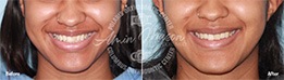 Woman smiling before and after tooth extractions and braces