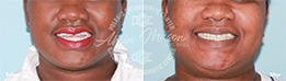 Patient smiling before and after treatment with braces and Invisalign clear aligners