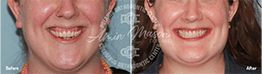 Woman smiling before and after surgical treatment of her open bite and braces