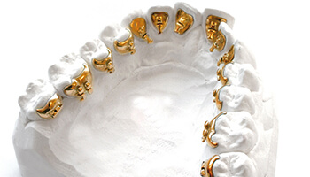 golden hidden braces