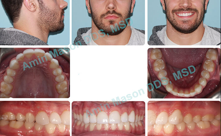 uneven gingiva case 1