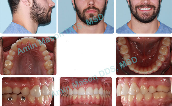 uneven gingiva case 2