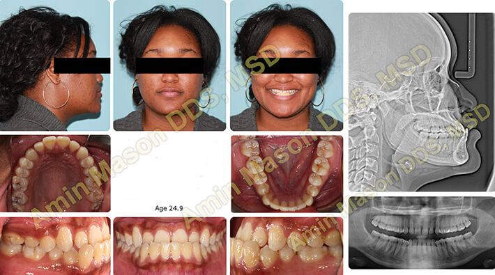 case 1 underbite