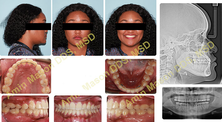 case 2 underbite