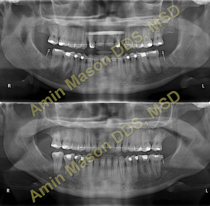 case 3 underbite