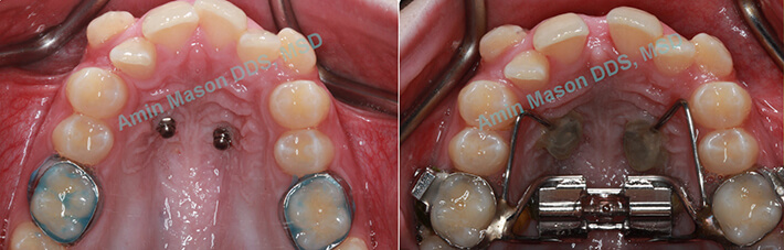 crossbite case 1