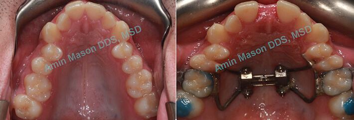 crossbite case 2