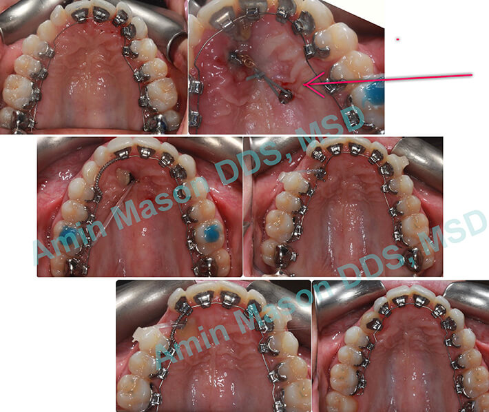 impacted canines case