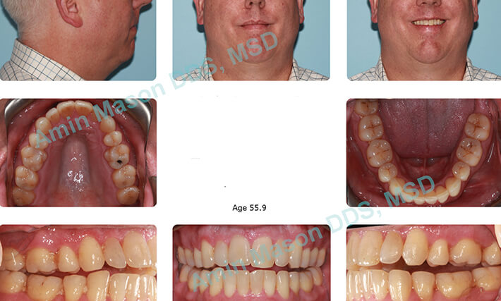 invisalign case 1