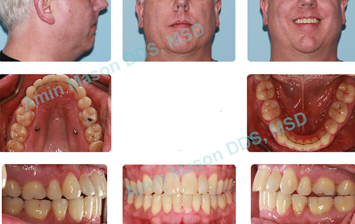 invisalign case 2