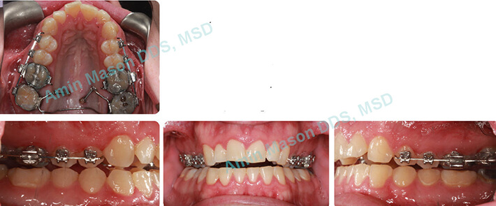 bite improvement case 2