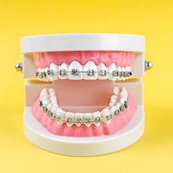 Dental model with braces against yellow background