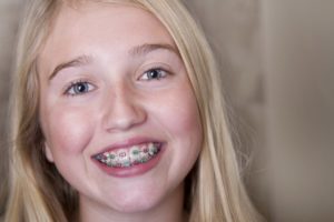 A child with metal braces.