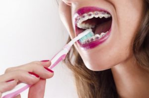 A woman with braces brushing her teeth.