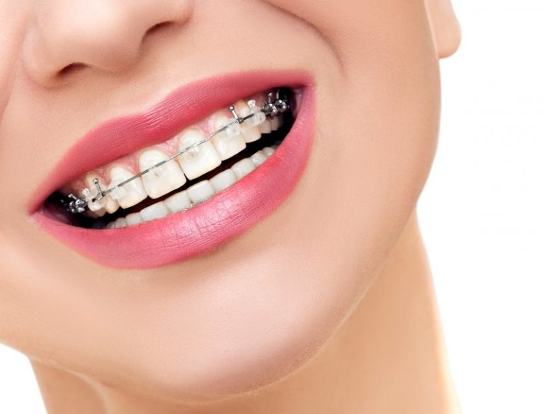 What is the Cost of Braces in Columbus, OH?