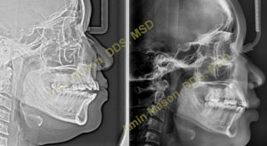 X ray of a side profile of a patient before and after orthodontic treatment