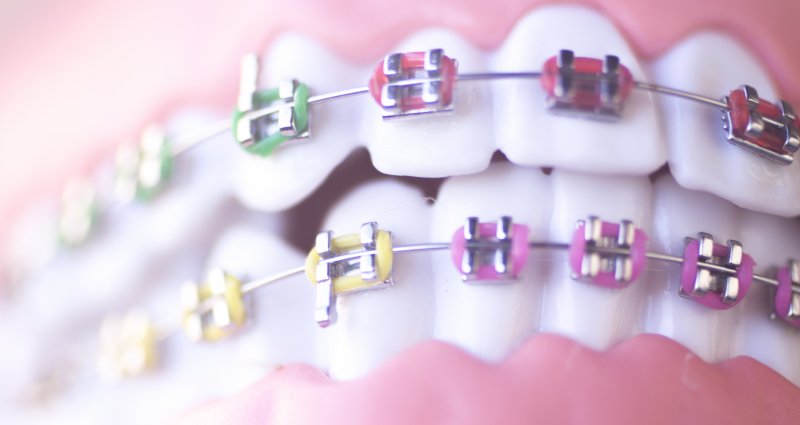 Close-up of braces with different colored bands