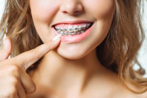 Close-up of woman’s smile as she points at her traditional braces