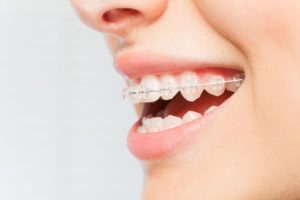 Close-up of person’s smile with clear ceramic braces